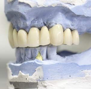 Vivaldent molde para prótesis dental dental